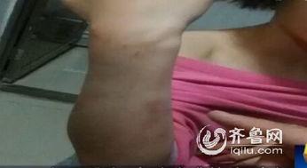 女生后背淤青图片,揭秘女生后背淤青之谜